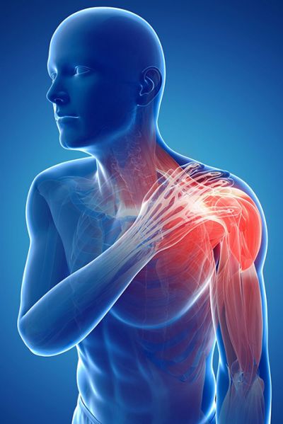 Schulterschmerz, das Impingement – Syndrom der Schulter
